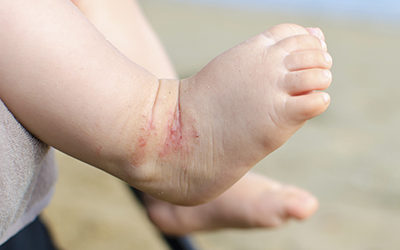 Eczema: Protect Your Baby’s Skin with Probiotics